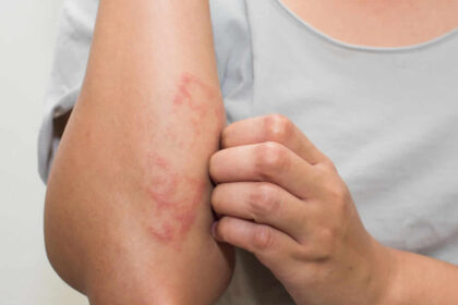 Eczema Tem Cura? Descubra a Verdade Sobre Esta Condição Comum da Pele Comunicação e Relacionamento